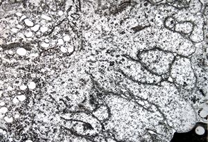 F,25y. | giant multinuclear osteoclast - aneurysmatic cyst - tibia F,25y. | giant multinuclear osteoclast - aneurysmatic cyst - tibia